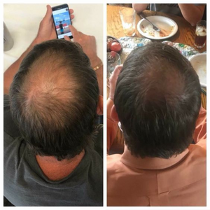 Purc™ | Natural Oil to Prevent Hair Loss