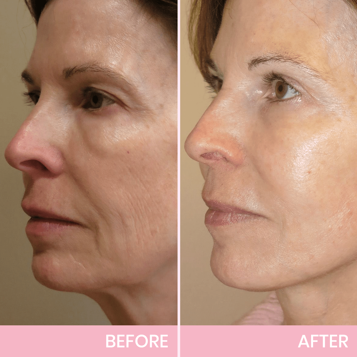 InvisiLift™ | Invisible Adhesive Tape for Face Lifting
