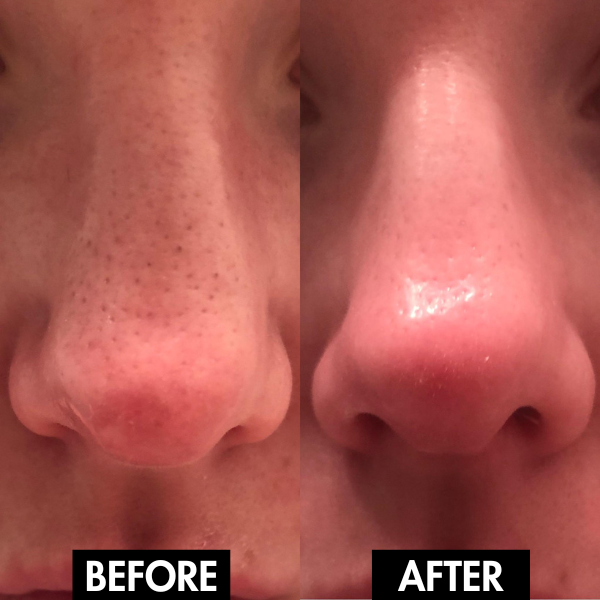 PurePore™ | Electric Facial Pore Vacuum