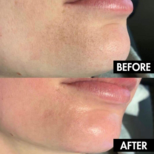PurePore™ | Electric Facial Pore Vacuum