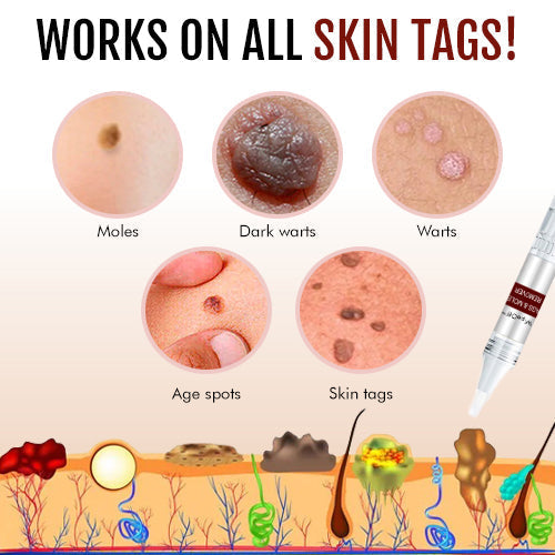 ClearMole™ | Tags & Moles Remover